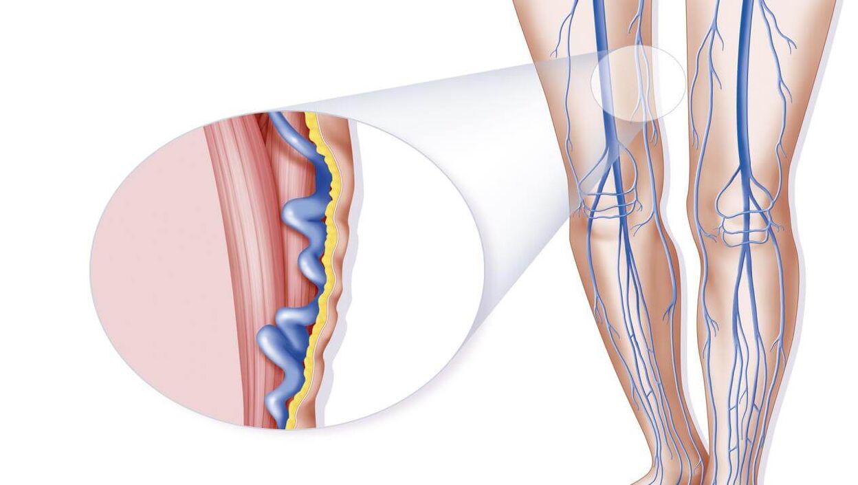 Causas de varizes